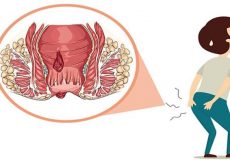 بواسیر یا هموروئید چیست؟ چه کسانی بیشتر در معرض این بیماری هستند؟
