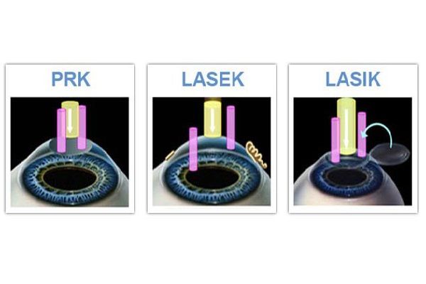 شرایط انجام عمل لیزیک، لازک و پی آر کی