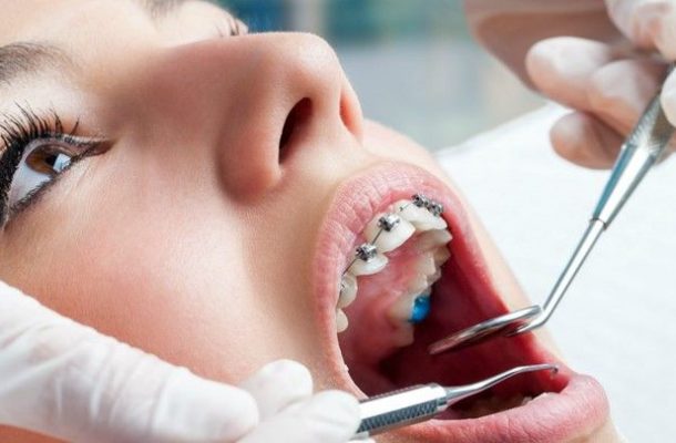 عصب کشی دندان در حین ارتودنسی