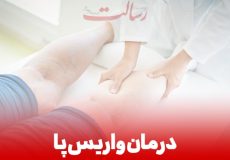 راه های درمان بیماری واریس و واریس پا