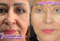 بررسی جراحی زیبایی لیفت شقیقه