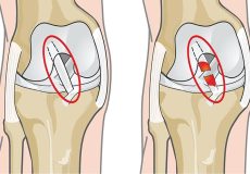 آشنایی با ۱۰ علامت پارگی رباط های زانو و ترمیم رباط پاره