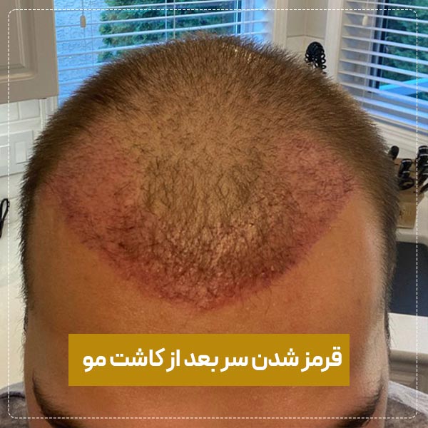 قرمزی سر بعد از کاشت مو